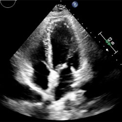 A sonogram of a heart.